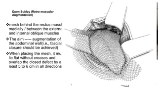 Sublay Retrorectus Management of Groin and Abdominal Wall Hernias.pptx