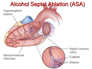 Alcohol Septal Ablation (ASA)
 