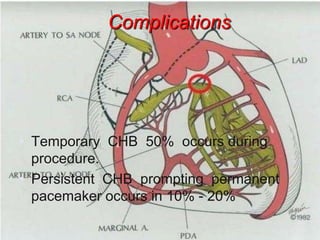 Complications
• Temporary CHB 50% occurs during
procedure.
• Persistent CHB prompting permanent
pacemaker occurs in 10% - 20%
 