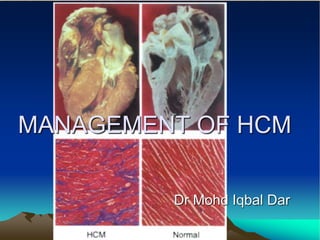 MANAGEMENT OF HCM
Dr Mohd Iqbal Dar
 
