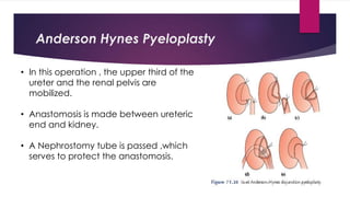 Anderson Hynes Pyeloplasty
• In this operation , the upper third of the
ureter and the renal pelvis are
mobilized.
• Anastomosis is made between ureteric
end and kidney.
• A Nephrostomy tube is passed ,which
serves to protect the anastomosis.
 