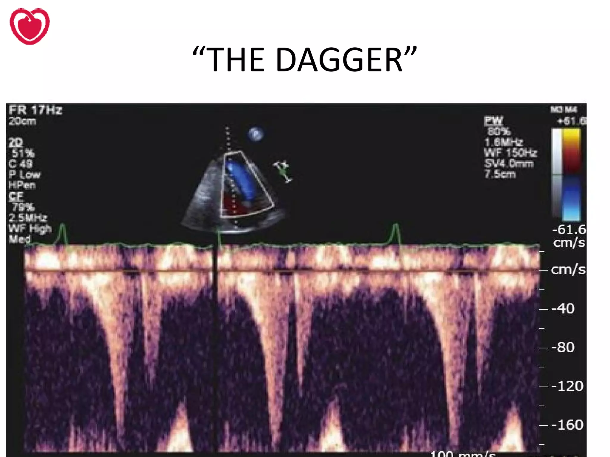 Dagger Dx Management of hypertrophic cardiomyopathy | PPT