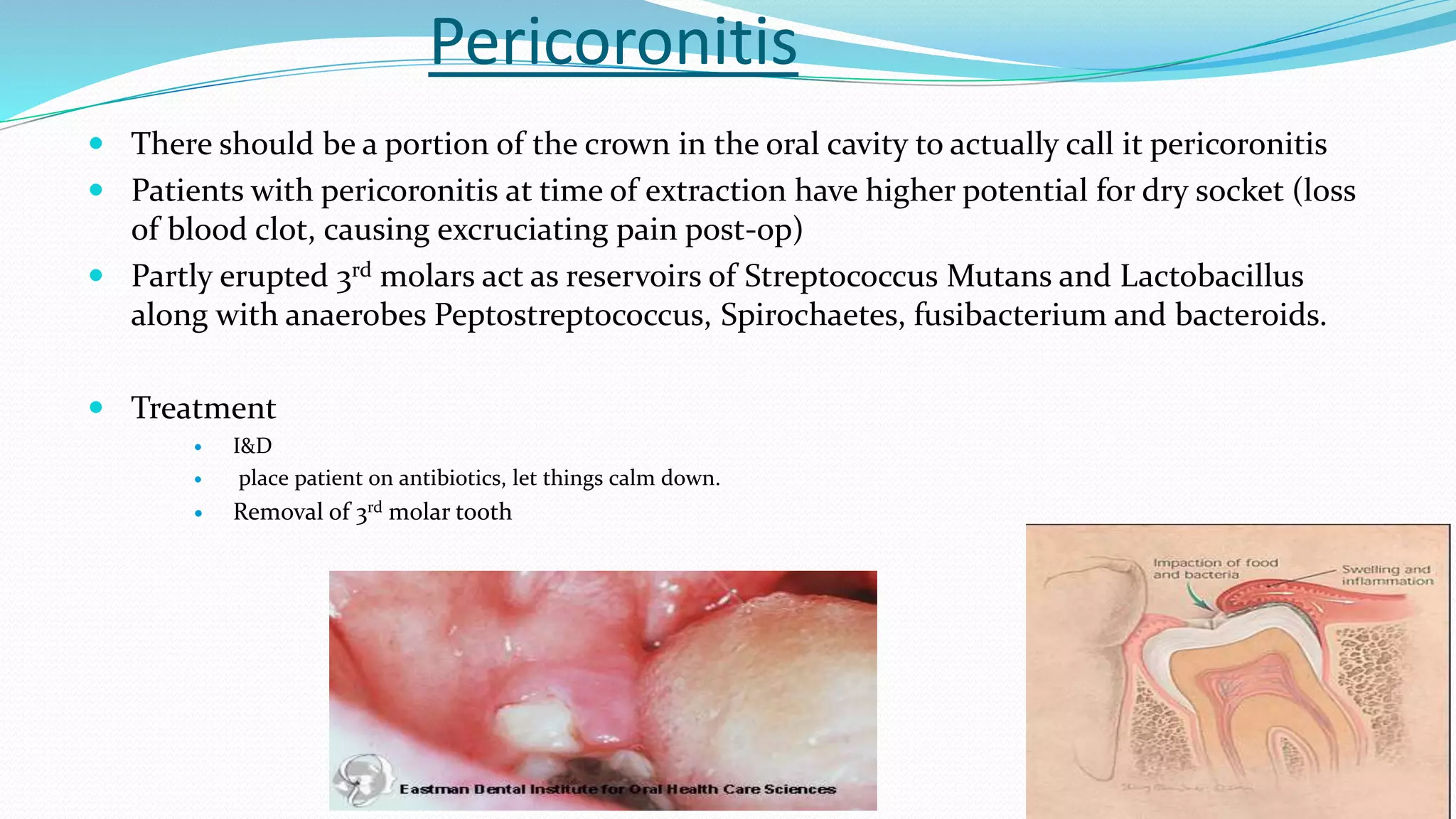 Pericoronitis
 There should be a portion of the crown in the oral cavity to actually call it pericoronitis
 Patients with pericoronitis at time of extraction have higher potential for dry socket (loss
of blood clot, causing excruciating pain post-op)
 Partly erupted 3rd molars act as reservoirs of Streptococcus Mutans and Lactobacillus
along with anaerobes Peptostreptococcus, Spirochaetes, fusibacterium and bacteroids.
 Treatment
 I&D
 place patient on antibiotics, let things calm down.
 Removal of 3rd molar tooth
 