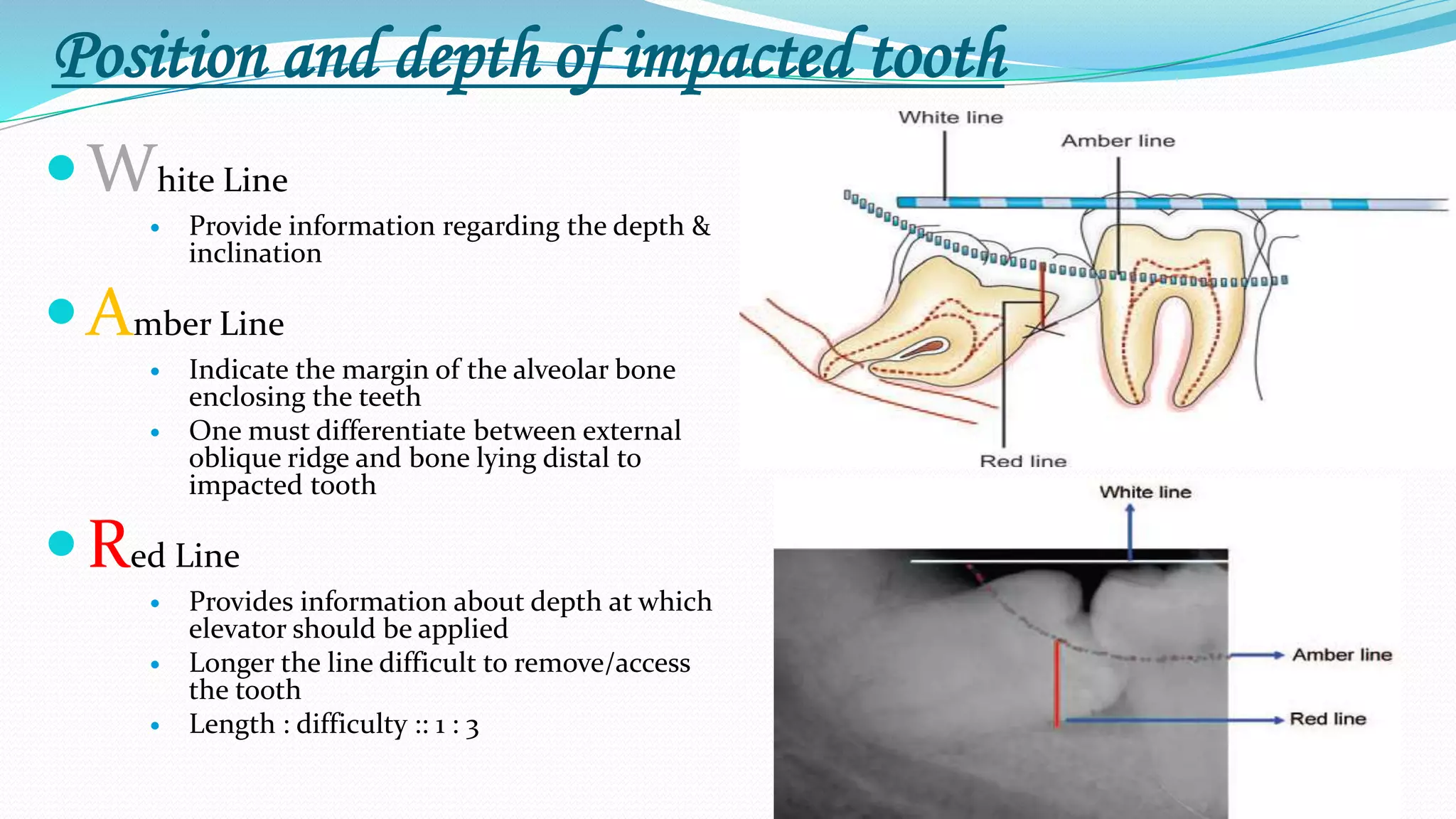 Position and depth of impacted tooth
White Line
 Provide information regarding the depth &
inclination
Amber Line
 Indicate the margin of the alveolar bone
enclosing the teeth
 One must differentiate between external
oblique ridge and bone lying distal to
impacted tooth
Red Line
 Provides information about depth at which
elevator should be applied
 Longer the line difficult to remove/access
the tooth
 Length : difficulty :: 1 : 3
 