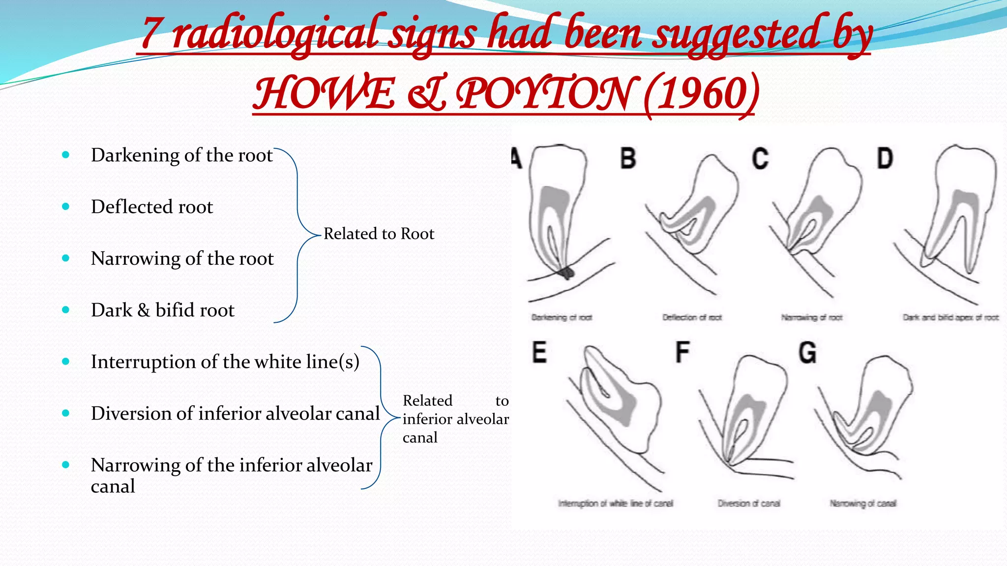 7 radiological signs had been suggested by
HOWE & POYTON (1960)
 Darkening of the root
 Deflected root
 Narrowing of the root
 Dark & bifid root
 Interruption of the white line(s)
 Diversion of inferior alveolar canal
 Narrowing of the inferior alveolar
canal
Related to Root
Related to
inferior alveolar
canal
 