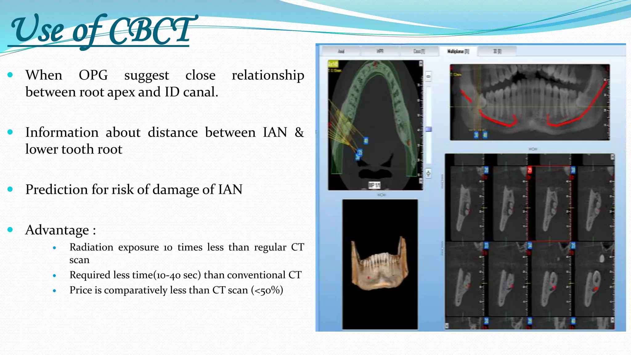 Use of CBCT
 When OPG suggest close relationship
between root apex and ID canal.
 Information about distance between IAN &
lower tooth root
 Prediction for risk of damage of IAN
 Advantage :
 Radiation exposure 10 times less than regular CT
scan
 Required less time(10-40 sec) than conventional CT
 Price is comparatively less than CT scan (<50%)
 