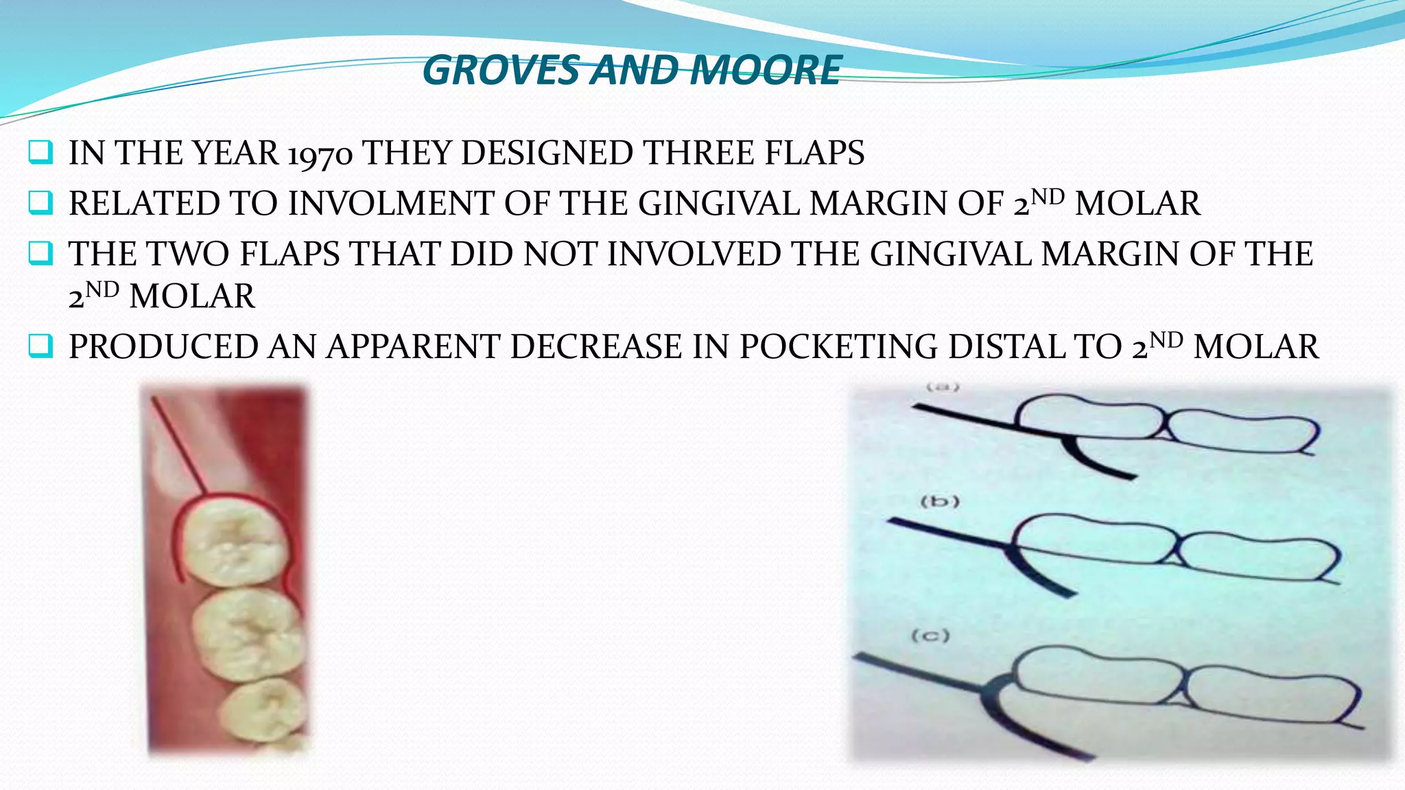 GROVES AND MOORE
 IN THE YEAR 1970 THEY DESIGNED THREE FLAPS
 RELATED TO INVOLMENT OF THE GINGIVAL MARGIN OF 2ND MOLAR
 THE TWO FLAPS THAT DID NOT INVOLVED THE GINGIVAL MARGIN OF THE
2ND MOLAR
 PRODUCED AN APPARENT DECREASE IN POCKETING DISTAL TO 2ND MOLAR
 