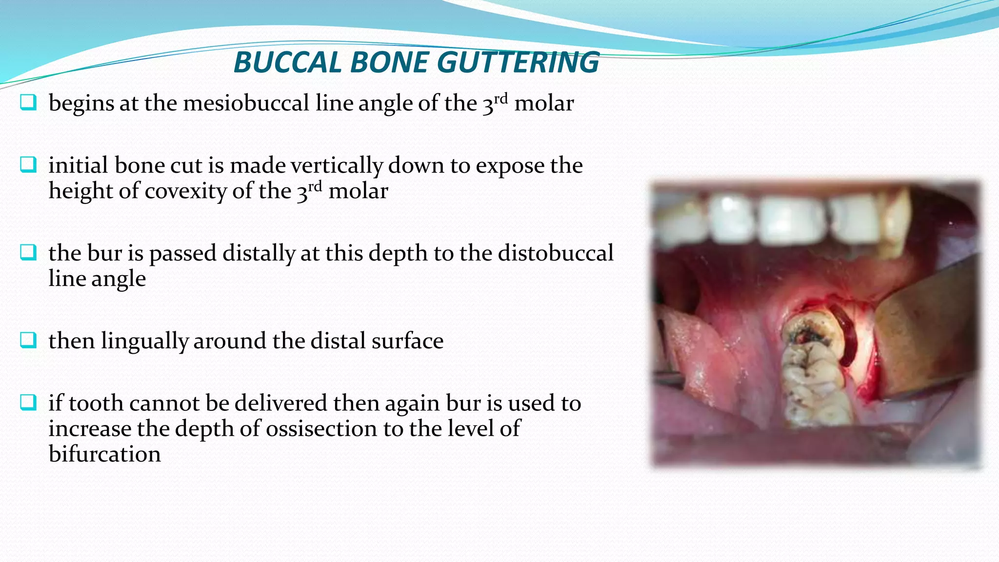 BUCCAL BONE GUTTERING
 begins at the mesiobuccal line angle of the 3rd molar
 initial bone cut is made vertically down to expose the
height of covexity of the 3rd molar
 the bur is passed distally at this depth to the distobuccal
line angle
 then lingually around the distal surface
 if tooth cannot be delivered then again bur is used to
increase the depth of ossisection to the level of
bifurcation
 