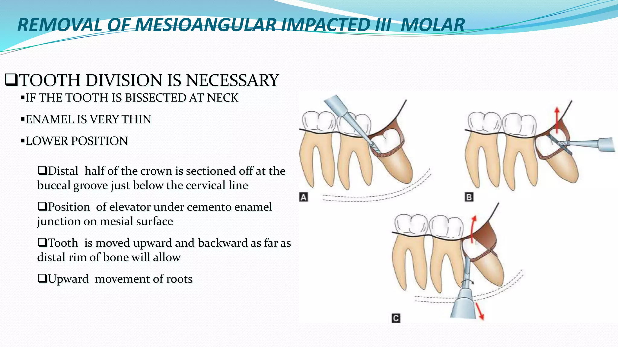 REMOVAL OF MESIOANGULAR IMPACTED III MOLAR
TOOTH DIVISION IS NECESSARY
IF THE TOOTH IS BISSECTED AT NECK
ENAMEL IS VERY THIN
LOWER POSITION
Distal half of the crown is sectioned off at the
buccal groove just below the cervical line
Position of elevator under cemento enamel
junction on mesial surface
Tooth is moved upward and backward as far as
distal rim of bone will allow
Upward movement of roots
 