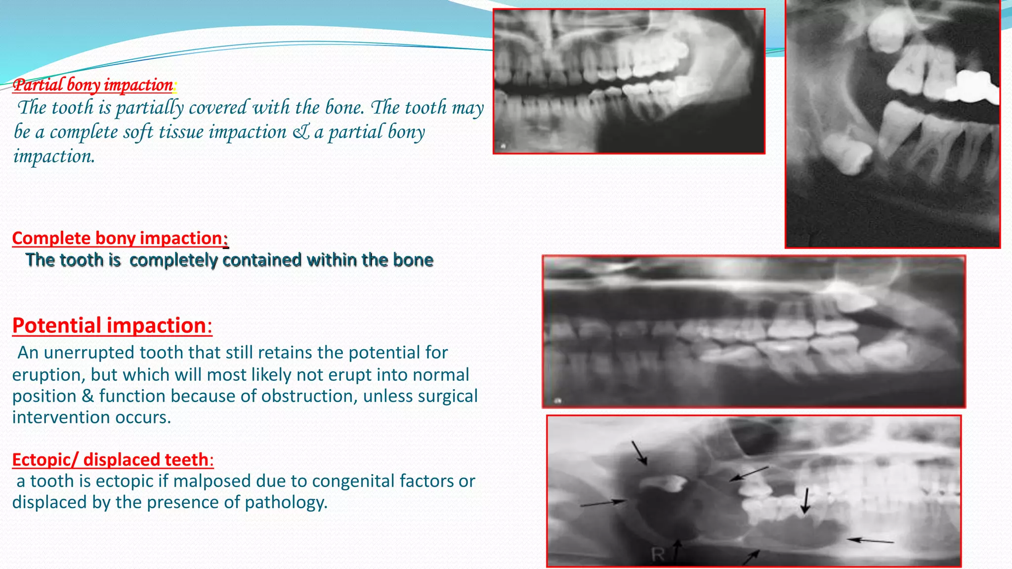 Partial bony impaction:
The tooth is partially covered with the bone. The tooth may
be a complete soft tissue impaction & a partial bony
impaction.
Complete bony impaction:
The tooth is completely contained within the bone
Potential impaction:
An unerrupted tooth that still retains the potential for
eruption, but which will most likely not erupt into normal
position & function because of obstruction, unless surgical
intervention occurs.
Ectopic/ displaced teeth:
a tooth is ectopic if malposed due to congenital factors or
displaced by the presence of pathology.
 