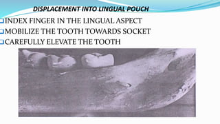 DISPLACEMENT INTO LINGUAL POUCH
INDEX FINGER IN THE LINGUAL ASPECT
MOBILIZE THE TOOTH TOWARDS SOCKET
CAREFULLY ELEVATE THE TOOTH
 