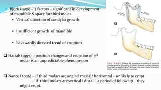  Bjork (1956) – 3 factors – significant in development
of mandible & space for third molar
 Vertical direction of condylar growth
 Insufficient growth of mandible
 Backwardly directed trend of eruption
 Hattab (1997) – position changes and eruption of 3rd
molar is an unpredictable phenomenon
 Nance (2006) – if third molars are angled mesial/ horizontal – unlikely to erupt
-- if third molars are vertical/ distal – a period of follow up – they
might erupt.
 