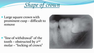 Shape of crown
 Large square crown with
prominent cusp – difficult to
remove
 “line of withdrawal” of the
tooth – obstructed by 2nd
molar – “locking of crown”
 