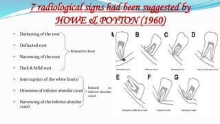 7 radiological signs had been suggested by
HOWE & POYTON (1960)
 Darkening of the root
 Deflected root
 Narrowing of the root
 Dark & bifid root
 Interruption of the white line(s)
 Diversion of inferior alveolar canal
 Narrowing of the inferior alveolar
canal
Related to Root
Related to
inferior alveolar
canal
 