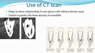Use of CT scan
 Helps to show relationship of root apices with inferior dental canal.
 Useful to predict the bone density of mandible
 