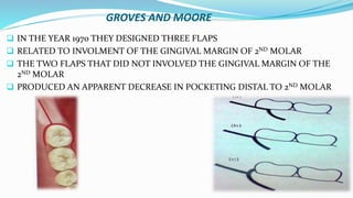 GROVES AND MOORE
 IN THE YEAR 1970 THEY DESIGNED THREE FLAPS
 RELATED TO INVOLMENT OF THE GINGIVAL MARGIN OF 2ND MOLAR
 THE TWO FLAPS THAT DID NOT INVOLVED THE GINGIVAL MARGIN OF THE
2ND MOLAR
 PRODUCED AN APPARENT DECREASE IN POCKETING DISTAL TO 2ND MOLAR
 