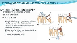 REMOVAL OF MESIOANGULAR IMPACTED III MOLAR
TOOTH DIVISION IS NECESSARY
IF THE TOOTH IS BISSECTED AT NECK
ENAMEL IS VERY THIN
LOWER POSITION
Distal half of the crown is sectioned off at the
buccal groove just below the cervical line
Position of elevator under cemento enamel
junction on mesial surface
Tooth is moved upward and backward as far as
distal rim of bone will allow
Upward movement of roots
 