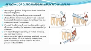 REMOVAL OF DISTOANGULAR IMPACTED III MOLAR
 Distoangular position brings the iii molar well under
the ascending ramus
 frequently distally curved roots are encountered
 after sufficient bone removal, the crown is sectioned
horizontally from the roots just above the cervical line
 the entire crown is first removed
 if roots if fused then a elevator can be straight used to
elevate the roots into the space previously occupied by
the crown
 if roots are divergent sectioning of roots is necessary
and individual removal
 extraction of this type of impaction is difficult,because
more distal bone has to be removed and the tooth
tends to be elevated distally and into the ramus
portion of the mandible
 