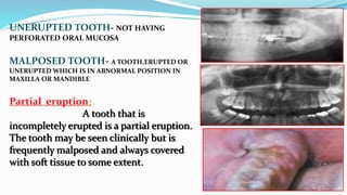 UNERUPTED TOOTH- NOT HAVING
PERFORATED ORAL MUCOSA
MALPOSED TOOTH- A TOOTH,ERUPTED OR
UNERUPTED WHICH IS IN ABNORMAL POSITION IN
MAXILLA OR MANDIBLE
Partial eruption:
A tooth that is
incompletely erupted is a partial eruption.
The tooth may be seen clinically but is
frequently malposed and always covered
with soft tissue to some extent.
 