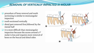REMOVAL OF VERTICALLY IMPACTED III MOLAR
 procedure of bone removal and tooth
sectioning is similar to mesioangular
impaction
 tooth sectioned vertically
 distal part removed first,followed by the
mesial half
 it is more difficult than mesioangular
impaction because the access around 2nd
molar is less and requires more removal of
bone on the buccal and distal sides
 