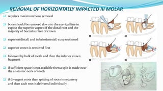 REMOVAL OF HORIZONTALLY IMPACTED III MOLAR
 requires maximum bone removal
 bone should be removed down to the cervical line to
expose the superior aspect of the distal root and the
majority of buccal surface of crown
 superior(distal) and inferior(mesial) cusp sectioned
 superior crown is removed first
 followed by bulk of tooth and then the inferior crown
fragment
 if sufficient space is not available then a split is made near
the anatomic neck of tooth
 if divergent roots then spitting of roots is necassery
and then each root is delivered individually
 