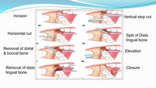 Vertical stop cut
Split of Disto
lingual bone
Elevation
Horizontal cut
Removal of distal
& buccal bone
Removal of disto
lingual bone
Incision
Closure
 