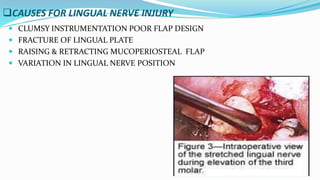 CAUSES FOR LINGUAL NERVE INJURY
 CLUMSY INSTRUMENTATION POOR FLAP DESIGN
 FRACTURE OF LINGUAL PLATE
 RAISING & RETRACTING MUCOPERIOSTEAL FLAP
 VARIATION IN LINGUAL NERVE POSITION
 