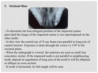 management OF IMPACTED CANINE LATEST.pptx