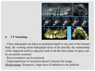 management OF IMPACTED CANINE LATEST.pptx
