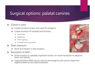 Management of impacted canines 2.pptx