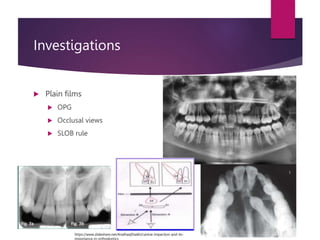 Slob Rule Management of impacted canines 2.pptx