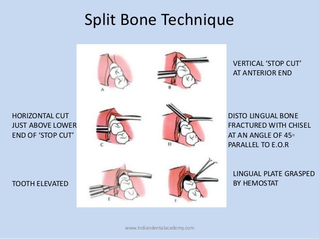 impacted tooth