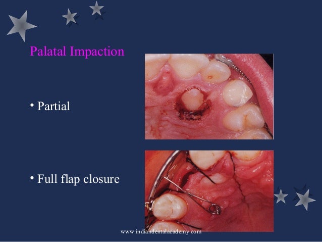 Management of impacted teeth /certified fixed orthodontic ...