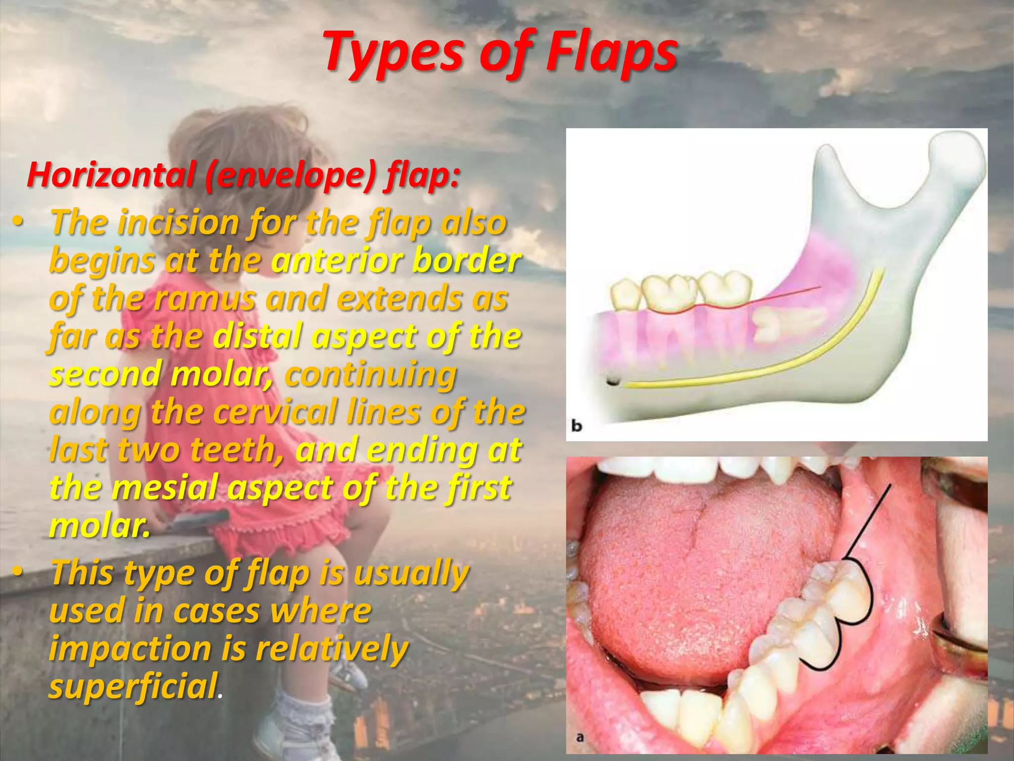 Management of impacted teeth | PPSX