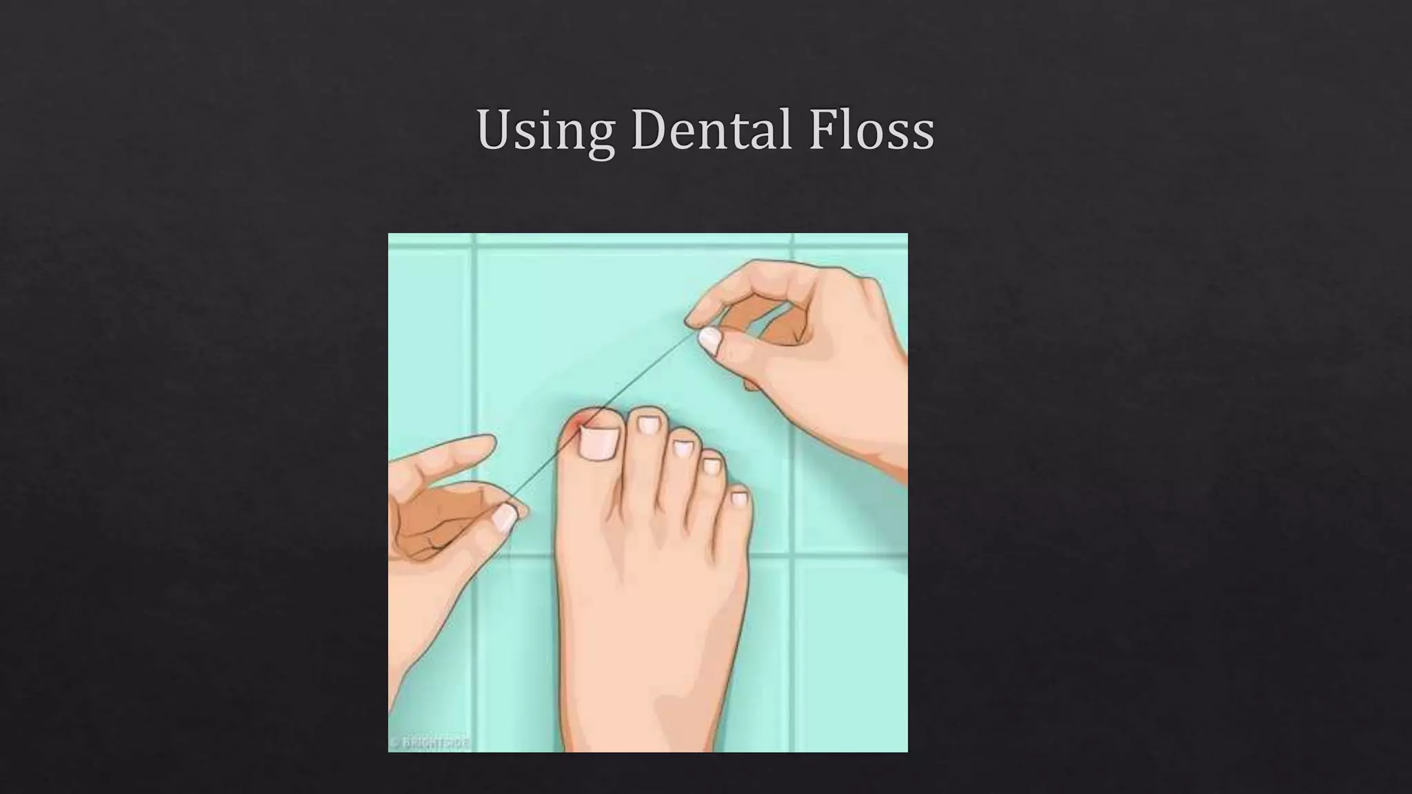 Toe Floss Management of ingrown toe nails | PPTX