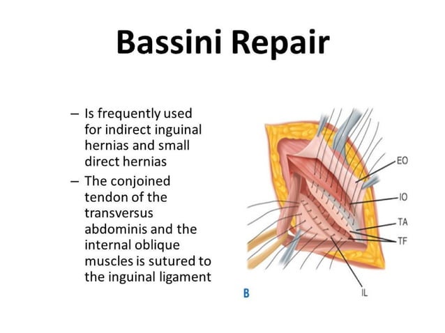 Mcvay Incision Management of inguinal hernia