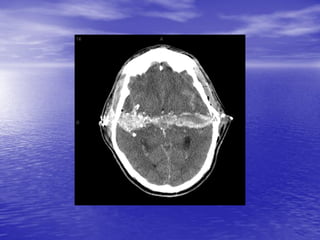 Management of Intercranial Pressure