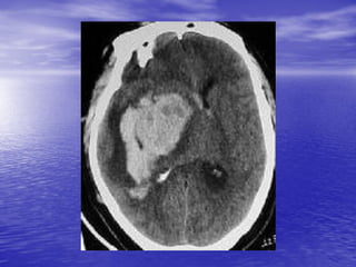 Management of Intercranial Pressure