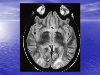 Management of Intercranial Pressure