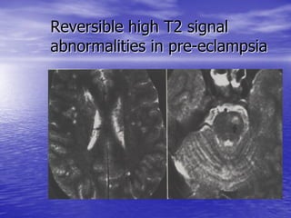 Management of Intercranial Pressure