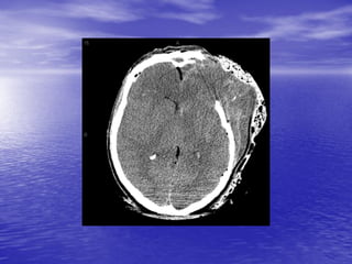 Management of Intercranial Pressure