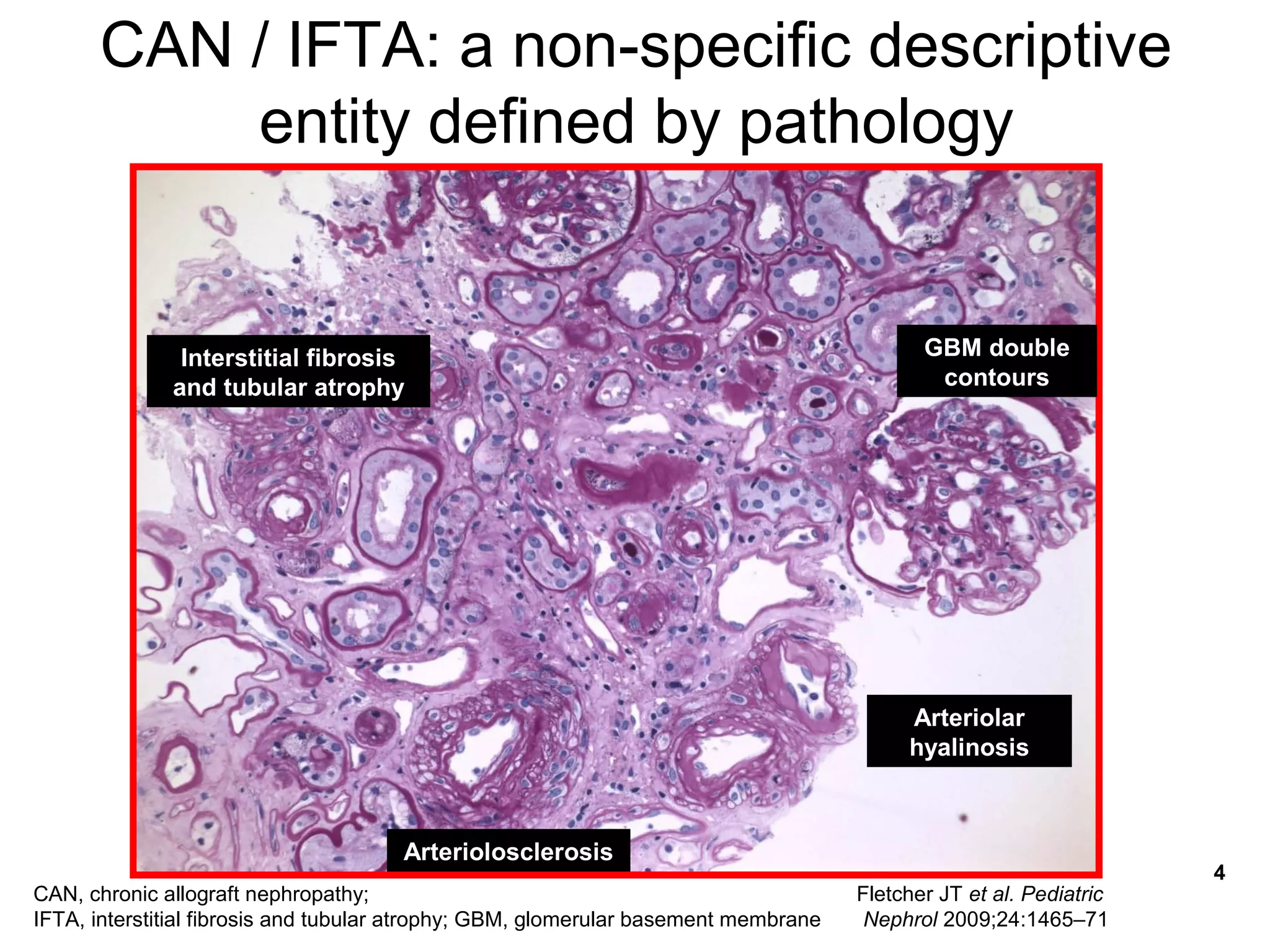 Management of interstitial fibrosis and tubular atrophy | PPT