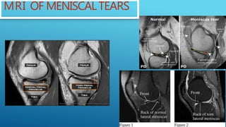 Management of knee cartilage defect & meniscus tear | PPTX