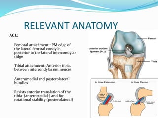 Intercondyler Ridge management of knee ligament injuries 2.pptx
