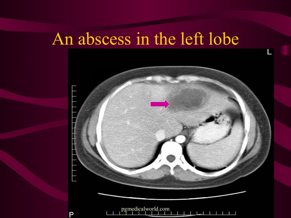Management of liver abscess