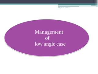 Management
of
low angle case
1
Dr Ravikanth Lakkakula
 