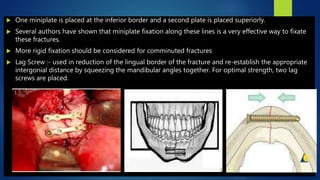 Management of Mandibular Fractures | PPTX