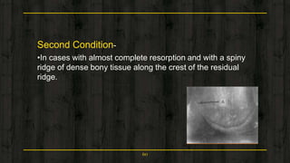 Second Condition-
•In cases with almost complete resorption and with a spiny
ridge of dense bony tissue along the crest of the residual
ridge.
60
 