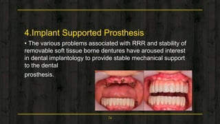 4.Implant Supported Prosthesis
• The various problems associated with RRR and stability of
removable soft tissue borne dentures have aroused interest
in dental implantology to provide stable mechanical support
to the dental
prosthesis.
74
 