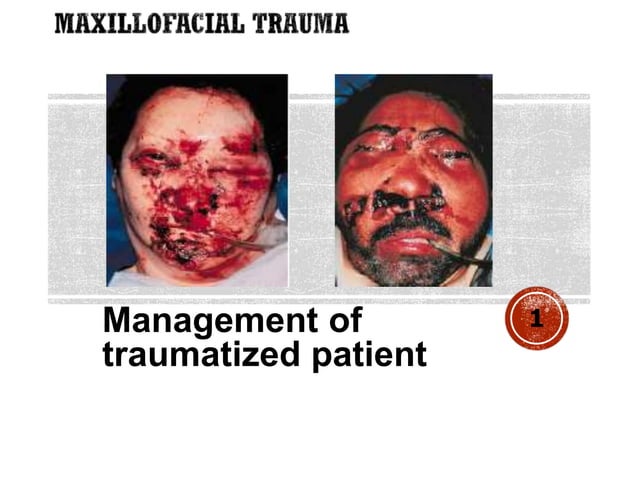 Management of maxillofacial trauma 1 copy | PPT